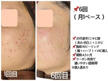 おうちサロン ミキ/20代前半ニキビ・跡悩み