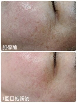 AI肌管理サロン レアリス【4月1日NEW OPEN】の写真/【AIで暴く、隠れたシミ予防に】今ある悩みも、未来の不安も。理論に基づく最新次世代エイジングケア