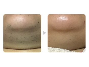 カレン 沖縄小禄店/脱毛結果１　あご