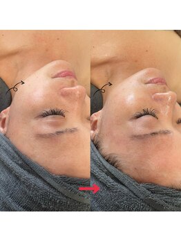 ダリア(Dahlia)/ハーブピーリング