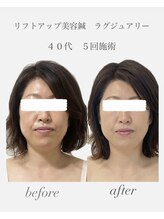 めい鍼灸院/ビフォーアフター若見え美容鍼灸