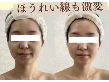 リコ(Rico)/左右差改善しパーツ際立つお顔に