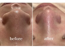 KMB 中崎町店/毛穴洗浄/モンロー式