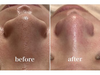 KMB 中崎町店/毛穴洗浄/モンロー式