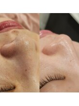 レイネイル レイエステティック 岐阜茜部店(RAY NAIL & RAY ESTHETIC)/毛穴角栓洗浄