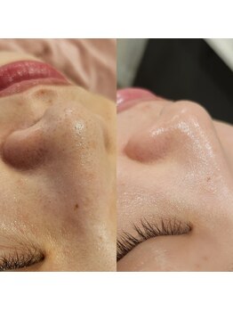 レイネイル レイエステティック 岐阜茜部店(RAY NAIL & RAY ESTHETIC)/毛穴角栓洗浄