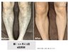 【男性限定】海・プール行く前に！！足全体脱毛　初回￥6000