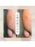 じっくりと集中ケア！タコ・魚の目ケア　60分6600円