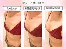 リール 恵比寿店(RIRE)/バストアップ症例【広尾恵比寿】