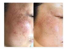 ストーリー(STORY)/ハーブピーリング専門店STORY