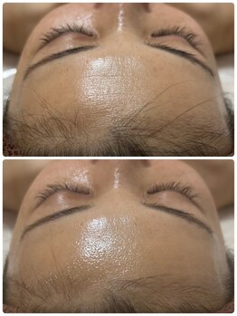 エルミナ.(elmina.)/おでこ丸みケア　脂肪増殖剤5ml