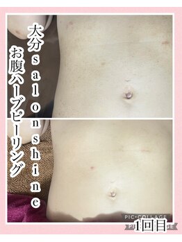 サロンシャイン(Salon Shine)/お腹ハーブピーリング