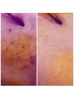 ダリア(DALIA)/ダメージ肌にエンビロン♪