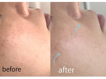 ルーム701(room701)/シミ　シワ　たるみ毛穴　毛穴