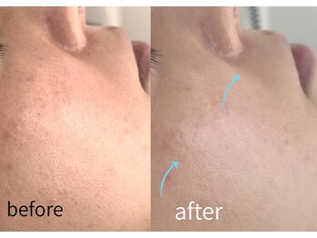 ルーム701(room701)/シミ シワ たるみ毛穴 毛穴