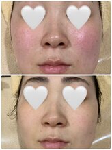 ジョアアンジェ 京橋店(joie ange)/日焼け後の赤み鎮静