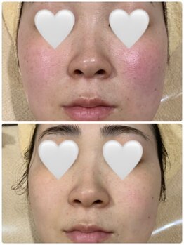 ジョアアンジェ 京橋店(joie ange)/日焼け後の赤み鎮静