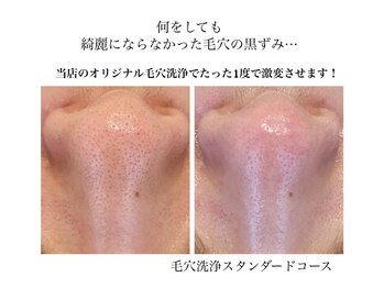 オルネ(ORNE.)/《毛穴洗浄スタンダード》