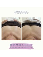 ベベ(Bebe)/光バストアップ