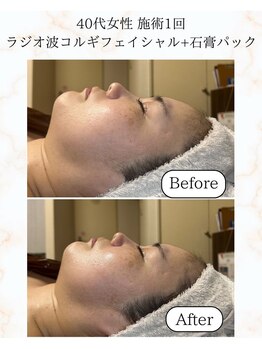 シーフェイス 横浜店(SEE FACE)/ラジオ波小顔コルギ+石膏パック