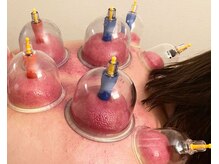 ラクラク健康堂 元町 中華街店(RAKURAKU健康堂)/即効性の高い吸い玉の施術