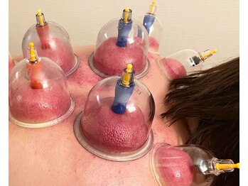 ラクラク健康堂 元町 中華街店(RAKURAKU健康堂)/即効性の高い吸い玉の施術