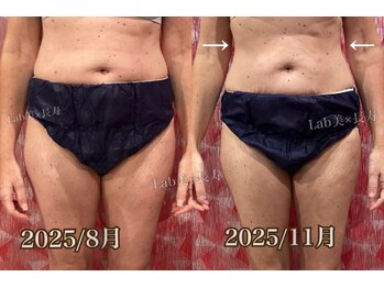 ラブ美長寿 沖縄本店(Lab)/【美肌痩身】下半身痩身コース