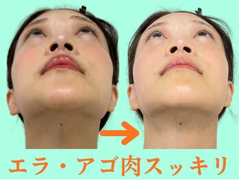 ナチュラルビューティーフェイス 横浜(NBF)/顎の歪みを整えて☆[横浜小顔]