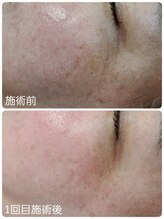 AI肌管理サロン レアリス【4月1日NEW OPEN】/プラズマ導入 シミケア