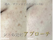 ココスターリー(Coco starry)/シミケア☆1ヶ月に1回2ヶ月後