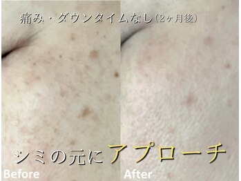 ココスターリー(Coco starry)/シミケア☆1ヶ月に1回2ヶ月後