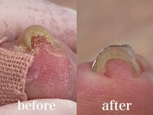 ドクターネイル爪革命 札幌本店/症例紹介１２　巻き爪