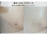 韓国ピーリング/水光肌【ざらつき・ニキビケア】ヒップLHAララピール¥9,800