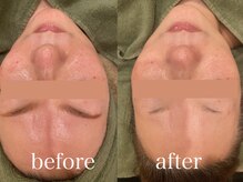 エピラックス(epilax)/プラズマパールリフト