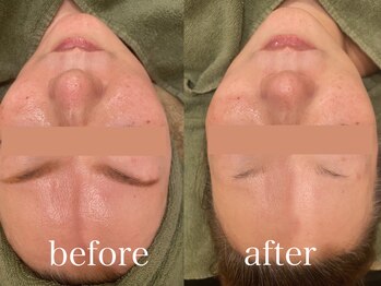 エピラックス(epilax)/プラズマパールリフト