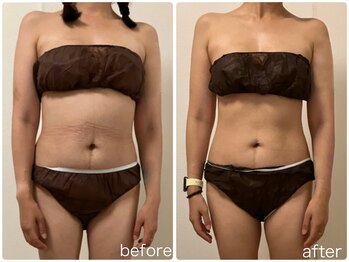 リリィブラン(Lily branc)/痩身/お腹ウエスト+デコルテ