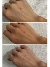 ヴィアージュ(Viage)/シミケア