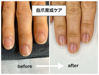 コバコ(kobaco)/縦長美爪へ　1年間の成果比較