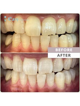 イージーホワイトニング 中野店(easy whitening)/セルフホワイトニング症例写真