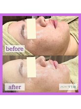 アヴァンス(AVANCE)/ハーブピーリング（1回）