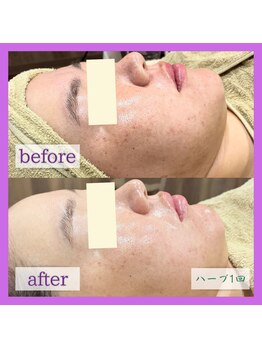 アヴァンス(AVANCE)/ハーブピーリング(1回)