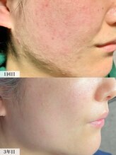 アンドミー 鳥取米子店(&me)&nbsp;ハーブ ピーリング