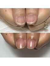 セラキュアネイル(Theracure nail)/ジェルネイルNGの方の地爪育成