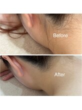 セラス(CERAS)/女性えりあし脱毛