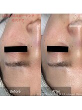 ロワゾーブリュ 代官山店(L'oiseau Bleu)/毛穴や乾燥にも効果抜群