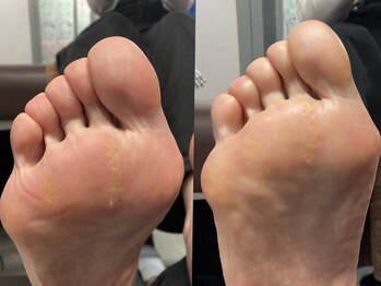 スフィーダ(SFIDA)/足裏ビフォーアフター
