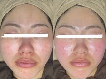 シンスプラス(SINCE+)/アンストレス×ハイドロ