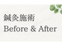 エヌアンドエヌ鍼灸院 福住店(N&えぬ鍼灸院)/鍼灸　Before & After