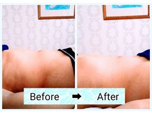 アリュール(ALLURE)/痩身ビフォーアフター1