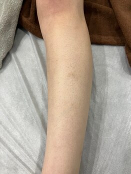 ムーンストーン(Moonstone)/高校生(腕)2回目施術前